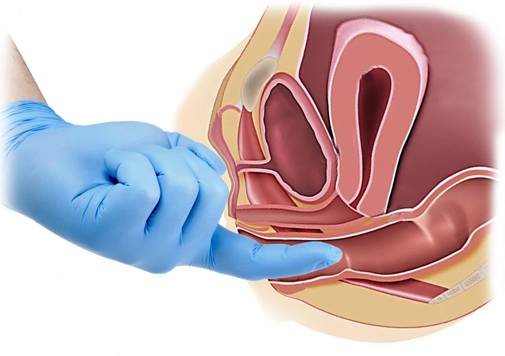 Пальцевое обследование прямой кишки - Изображение 1