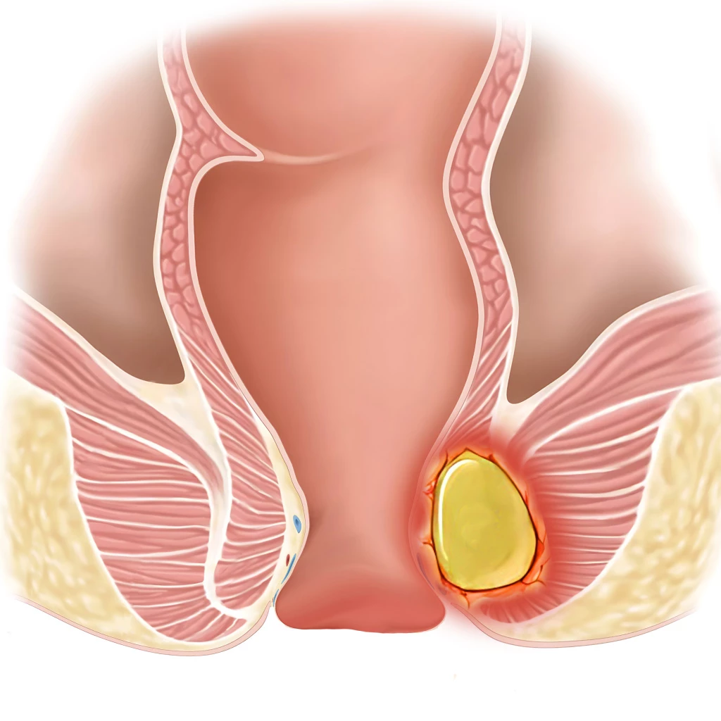 Хронический парапроктит - Изображение 1