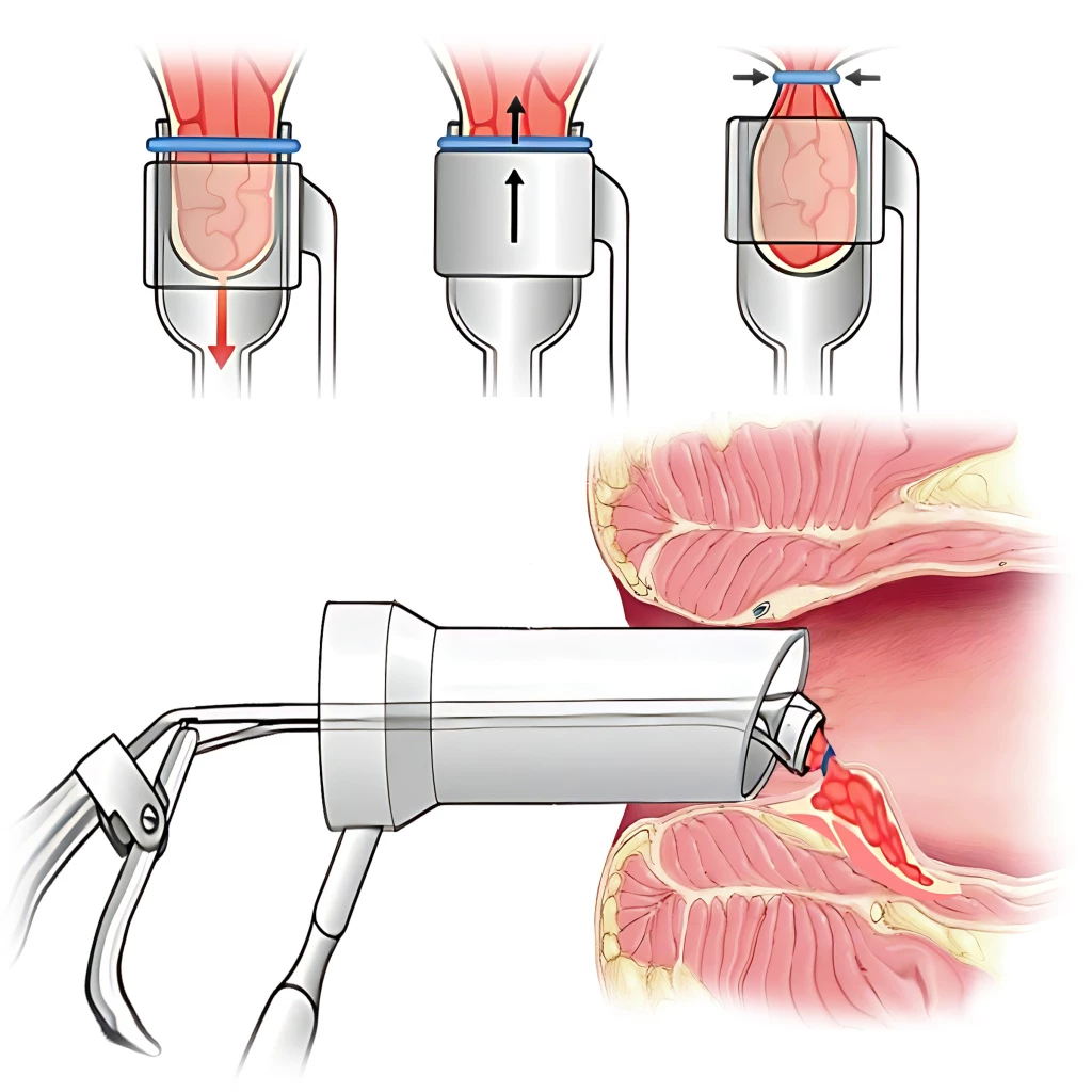 Латексное лигирование геморроя - Изображение 1