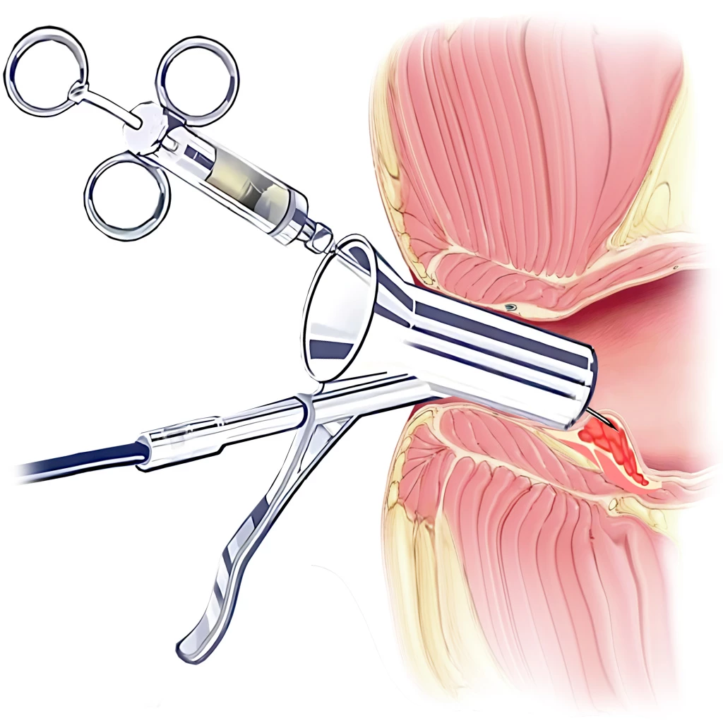 Склерозирование геморроидальных узлов - Изображение 1